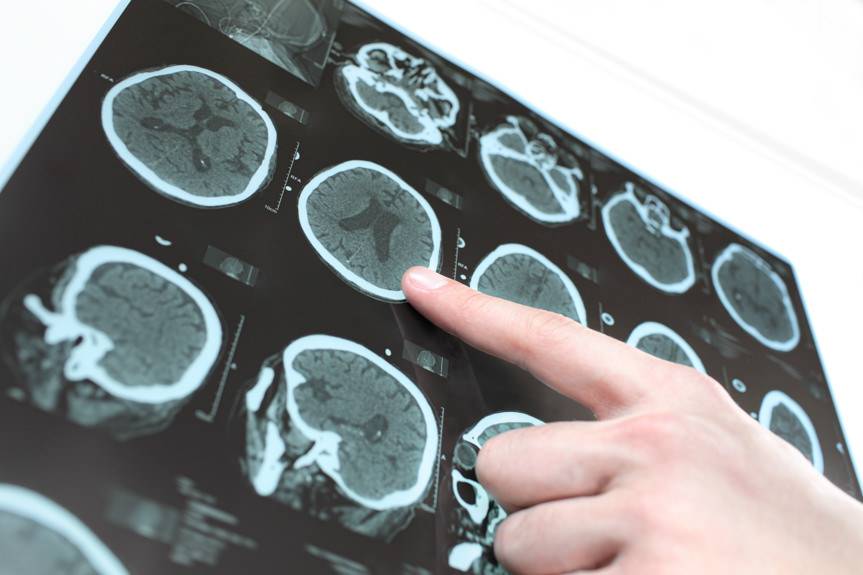 Krosno. Wstrzymane przyjęcia na oddział neurologiczny szpitala