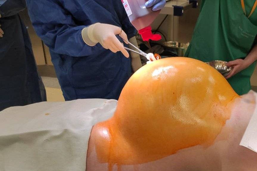 Gigantyczny guz w ciele pacjentki. Ważył 30 kilogramów