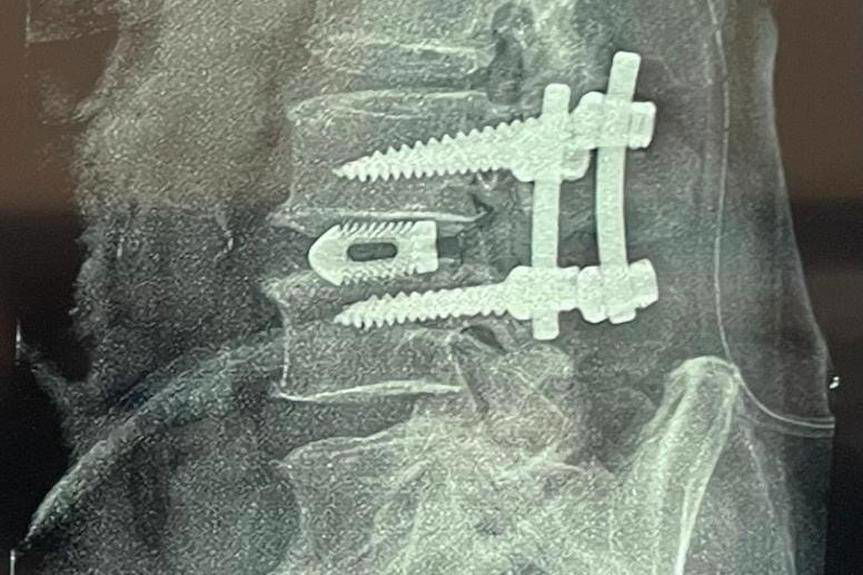 Koniec z bólem kręgosłupa. Nowe techniki operacyjne w Krośnie